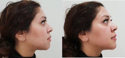 Chin Filler before and after photo