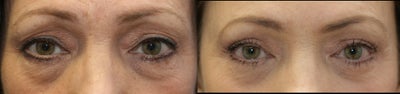 Eyelid Surgery before and after photo