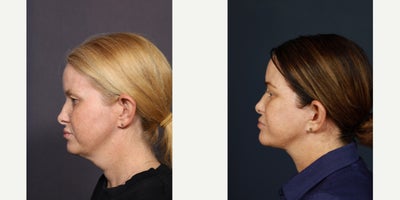 Eyelid Surgery before and after photo
