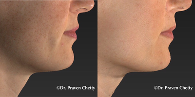 IPL before and after photo