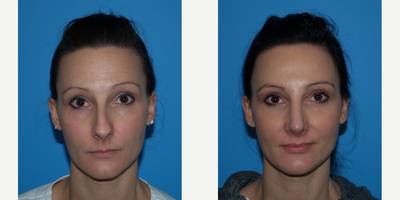 Rhinoplasty before and after photo