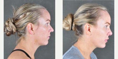 Rhinoplasty before and after photo