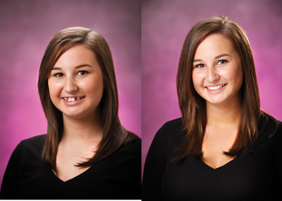 Smile Makeover before and after photo