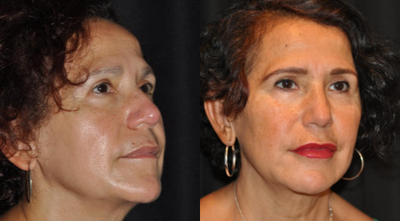 Dermal Fillers before and after photo