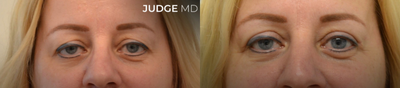 Eyelid Surgery before and after photo
