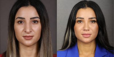 Rhinoplasty before and after photo