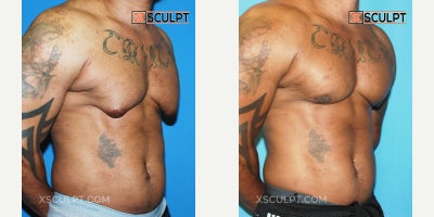 Vaser Liposuction before and after photo