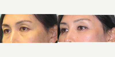 Double Eyelid Surgery before and after photo