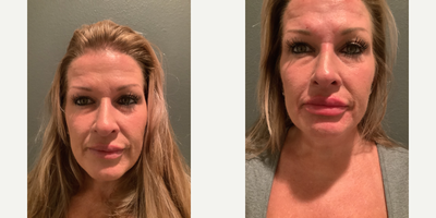 Lip Fillers before and after photo