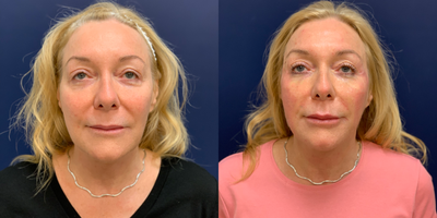 Thread Lift before and after photo