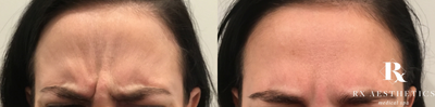 Dysport before and after photo