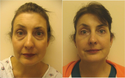 Facelift before and after photo