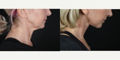 Facelift before and after photo