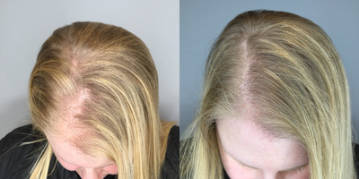 PRP for Hair Loss before and after photo