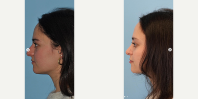 Rhinoplasty before and after photo