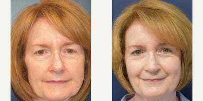 Rhinoplasty before and after photo