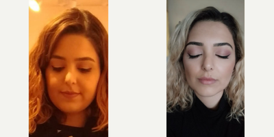Buccal Fat Removal before and after photo
