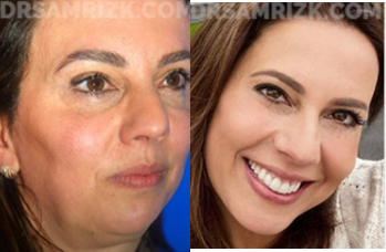 Facelift before and after photo