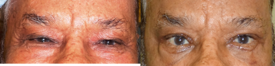 Brow Lift before and after photo