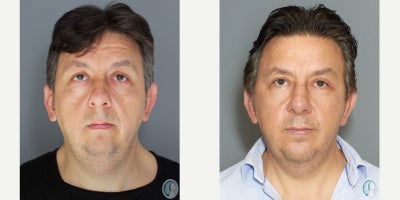 Deep Plane Facelift before and after photo