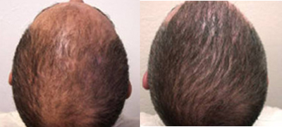 FUE Hair Transplant before and after photo