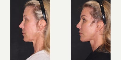 Neck Lift before and after photo
