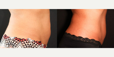 Tummy Tuck before and after photo