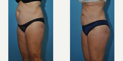 Liposuction before and after photo