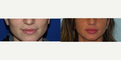 Restylane before and after photo