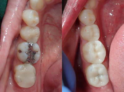 Dental Crown before and after photo