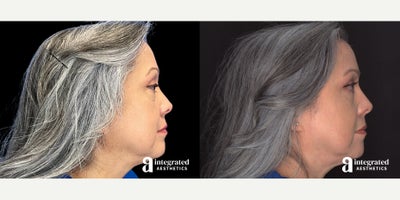 Eyelid Surgery before and after photo