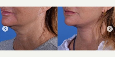 Facelift Revision before and after photo