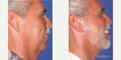 Liposuction before and after photo