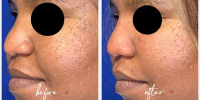 Nonsurgical Nose Job before and after photo