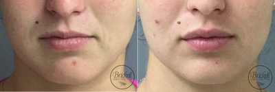 Restylane Silk before and after photo