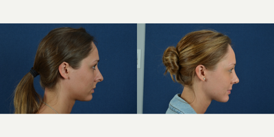 Rhinoplasty before and after photo