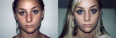 Rhinoplasty before and after photo