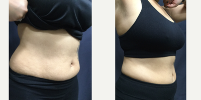 SculpSure before and after photo