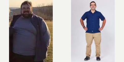 Gastric Sleeve Surgery before and after photo