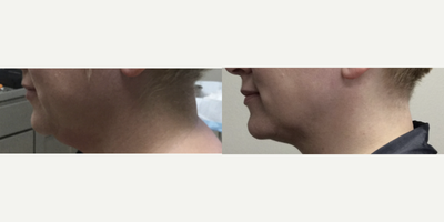 Kybella before and after photo