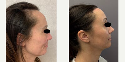 Forehead Reduction before and after photo