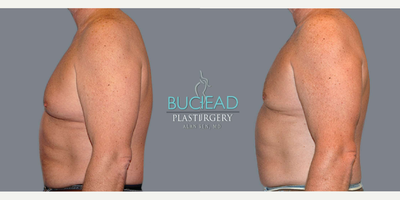 Gynecomastia Surgery before and after photo