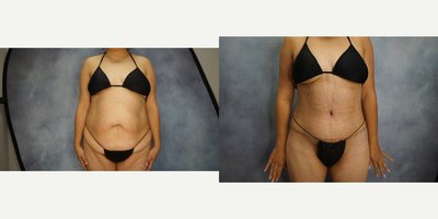 Tummy Tuck before and after photo