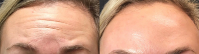 Botox before and after photo