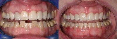 Braces before and after photo
