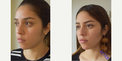 Buccal Fat Removal before and after photo