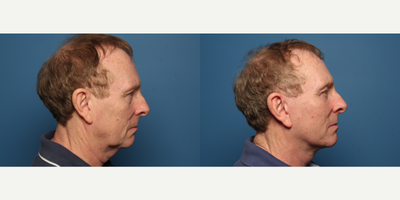 Facelift before and after photo