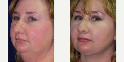 Facelift before and after photo