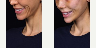 Facelift before and after photo