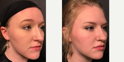Lip Fillers before and after photo